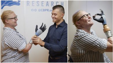 Persona con mano bionica dopo aver perso la mano 20 anni fa, una vera innovazione