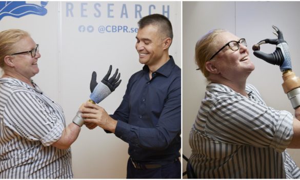 Protesi bionica sostituisce mano perduta dopo 20 anni, un nuovo traguardo