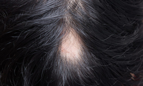 Alopecia areata