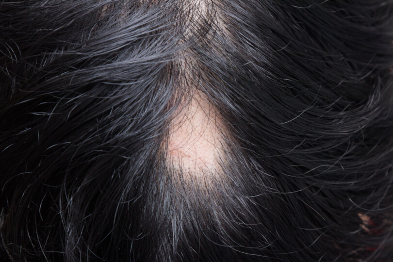 Alopecia areata